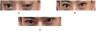 Rare Co-occurrence of Ocular Myasthenia Gravis and Thyroid-Associated Orbitopathy (Ophthalmopathy) in an Individual With Hypothyroidism